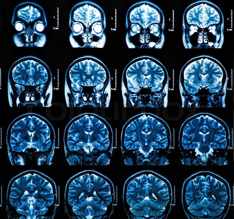 Une équipe de chercheurs de la Colorado University reçoit 11 millions de dollars pour élucider les mystères du cerveau des adolescents