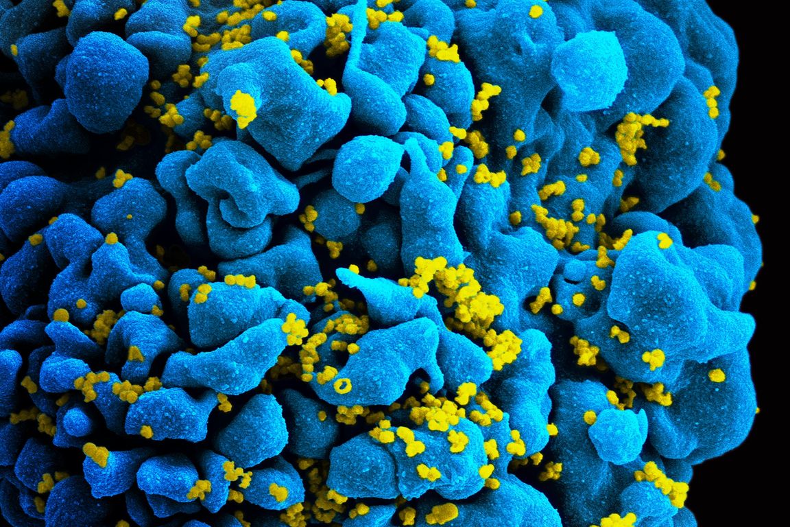 Des chercheurs de UCLA reçoivent près de 14 millions de dollars du NIH pour étudier la thérapie génique dans le combat contre le VIH
